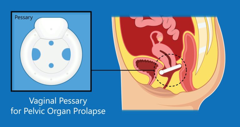 What is pelvic organ prolapse and how is it treated?