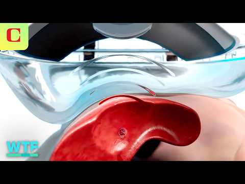 Destroying Tumors with SOUND: Histotripsy Demo & Explainer