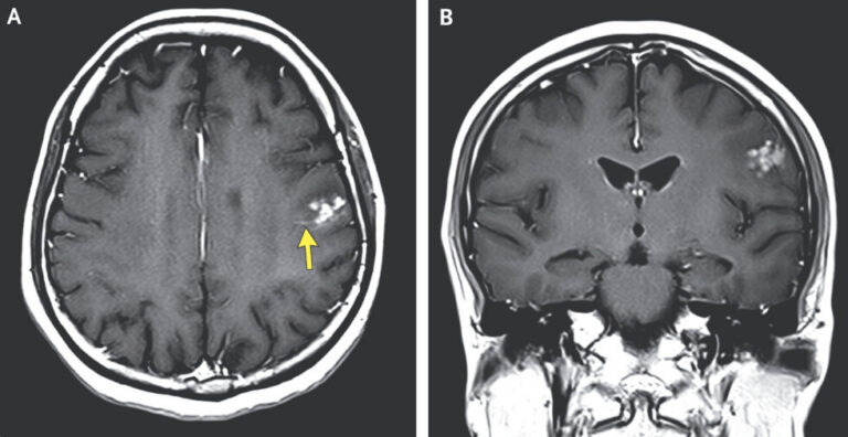 Woman's brain worm infection confirmed after eggs grow tails in lab test
